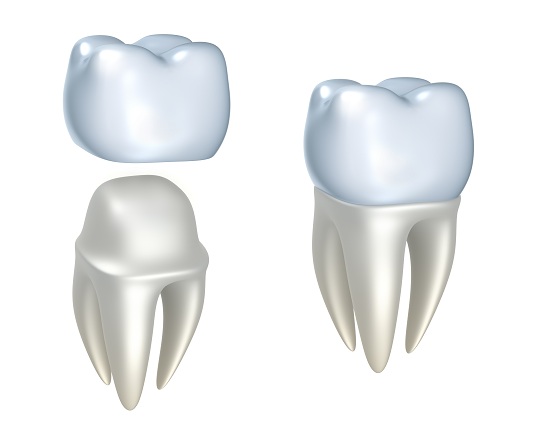 What is a Dental Crown? - Dentists