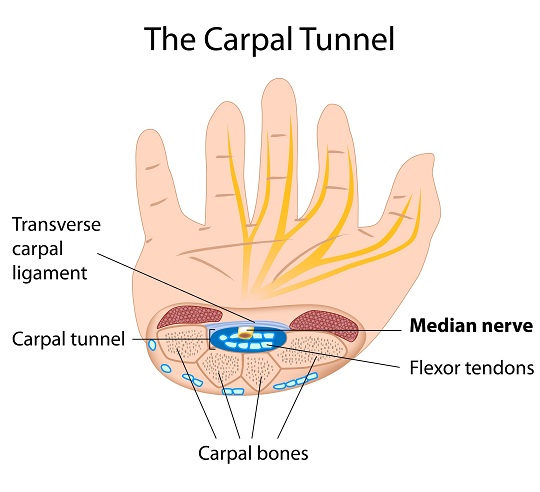 Chiropractic Treatment for Carpal Tunnel Syndrome - Chiropractors