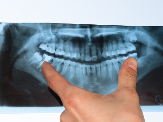 Impacted Wisdom Teeth Symptoms