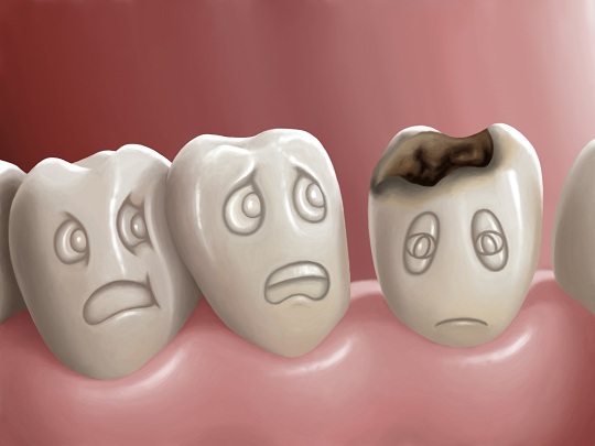 Signs of Cavities