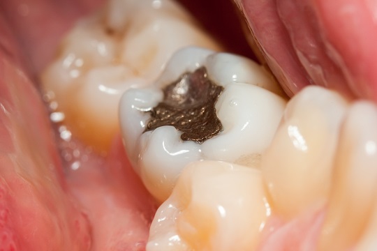 Composite vs Amalgam Fillings
