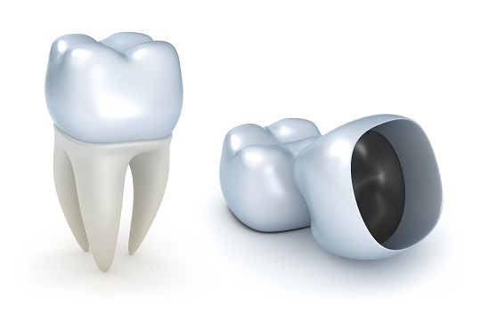 Difference Between Dental Caps and Crowns