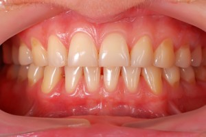 Gums Bleed When Brushing - Dentists