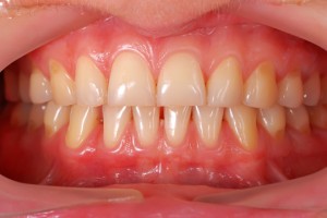 Gums Bleed When Brushing - Dentists