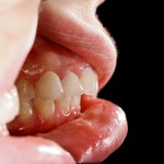 Why Do My Gums Bleed When I Floss? - Dentists