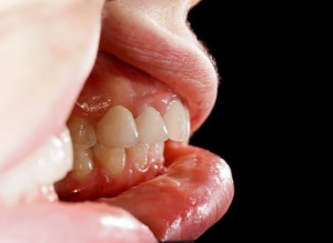 Why Do My Gums Bleed When I Floss? - Dentists