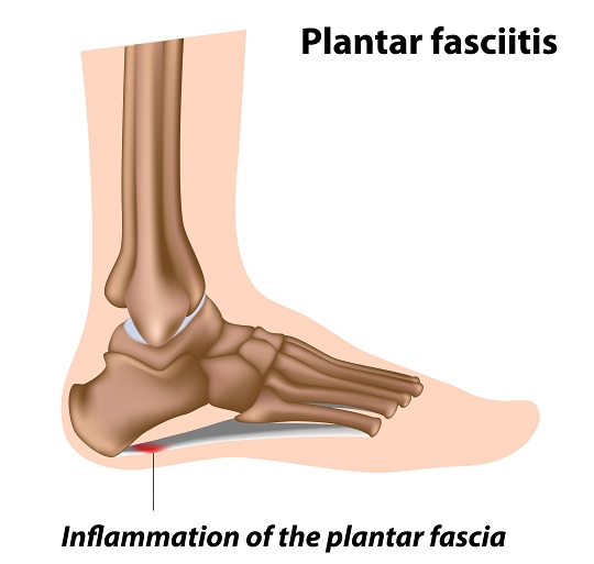 Symptoms of Plantar Fasciitis