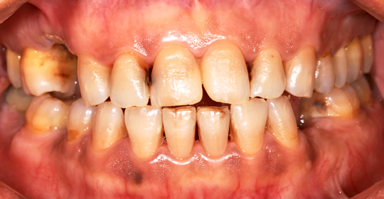 Private: How to Cure Gingivitis Symptoms