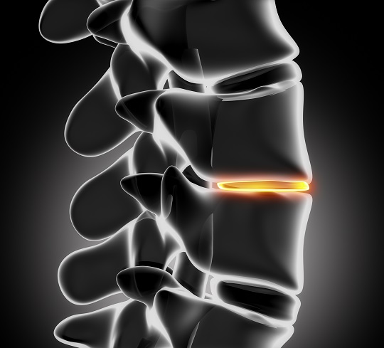 Chiropractic Treatment for Herniated Disc