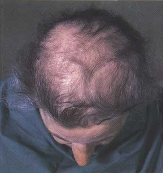 Low Level Laser Therapy Hair Loss - Chiropractors